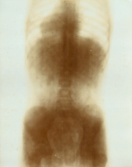 Prof. Contremoulin (attributed to) - Large X-ray of a Child's Torso